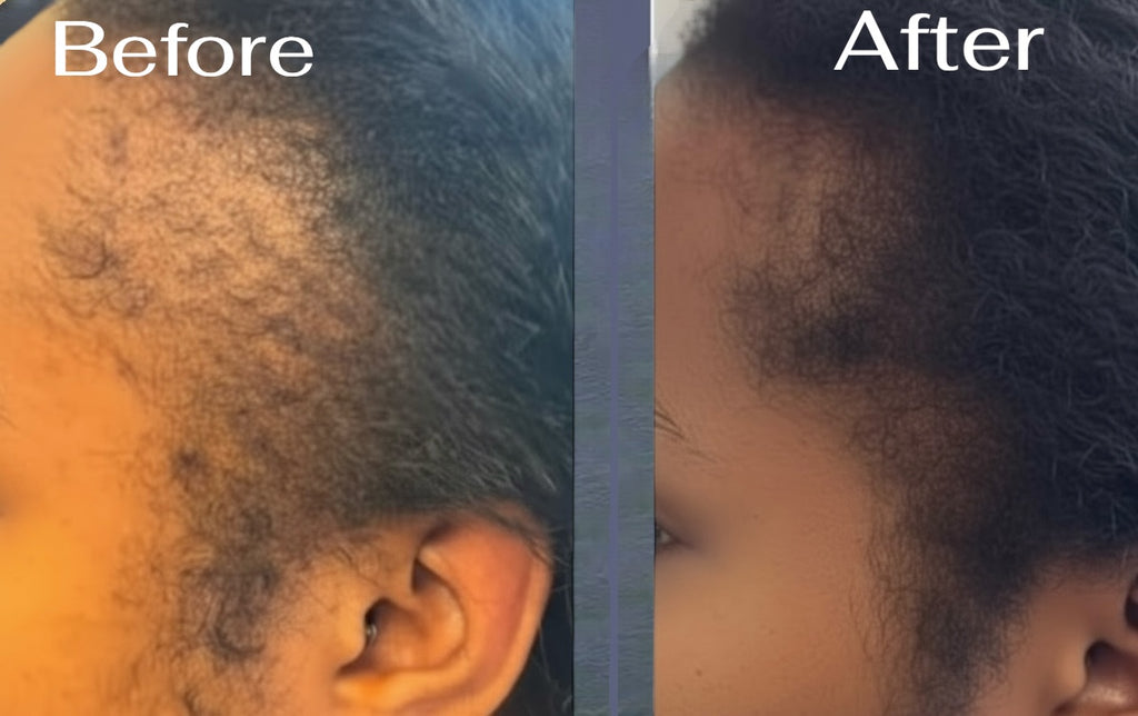 Before and after comparison of a person's head hairline.