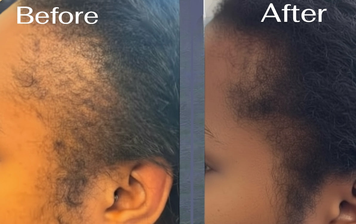 Before and after comparison of a person's head hairline.
